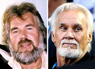 Kenny Rogers Facelift Before And After