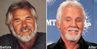 Kenny Rogers Plastic Surgery Disaster
