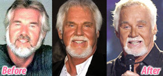 Kenny Rogers Plastic Surgery Photos