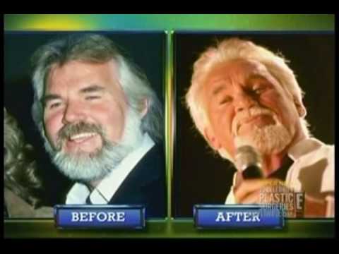 Kenny Rogers Plastic Surgery Pictures Before After