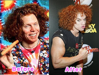 Kenny Rogers Plastic Surgery Pictures Before After